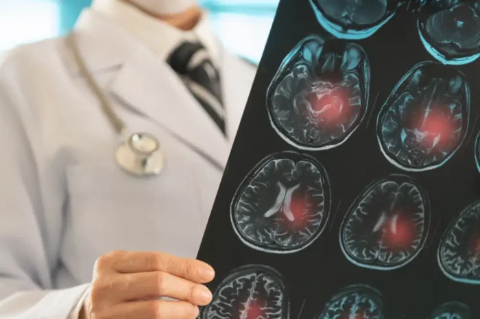 Φάρμακο βοηθά στην μείωση των επαναλαμβανόμενων εγκεφαλικών επεισοδίων – Ο ρόλος της Ελλάδας στη μελέτη